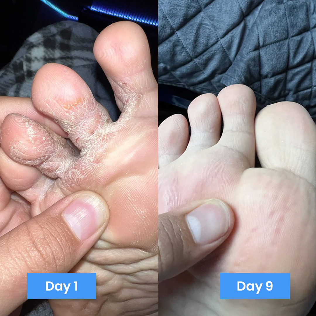 New Aura™ Anti-Fungal Relief Cream