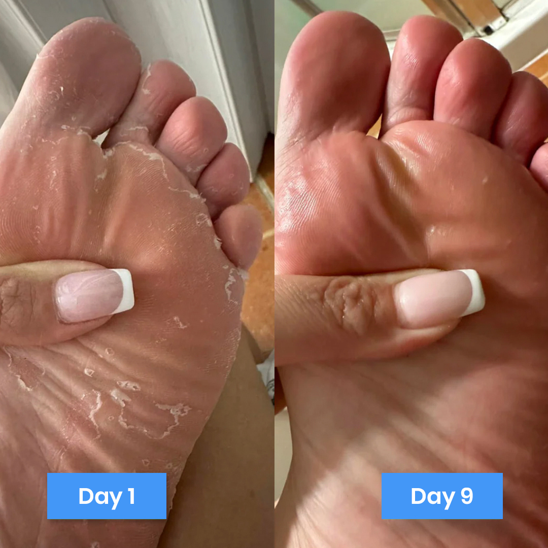 New Aura™ Anti-Fungal Relief Cream