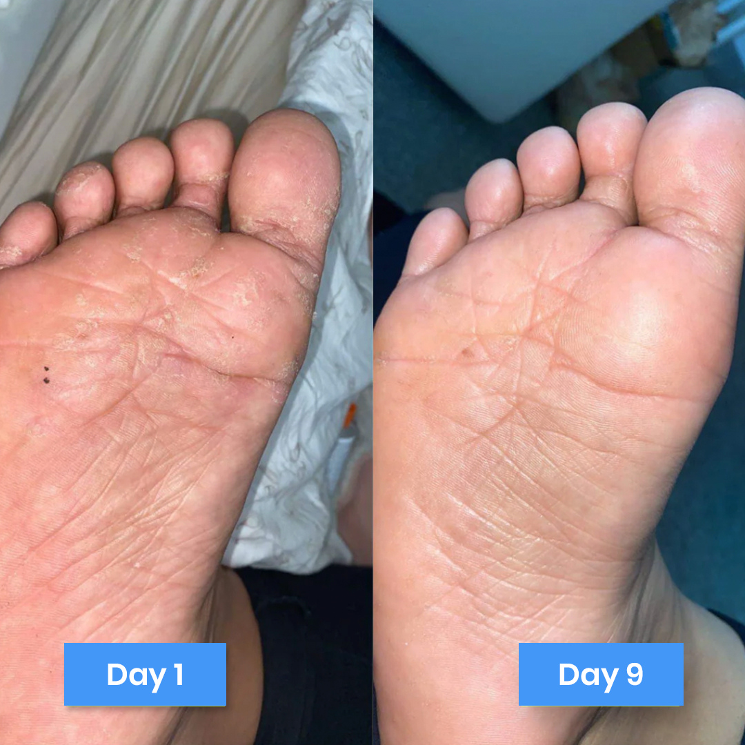 New Aura™ Anti-Fungal Relief Cream