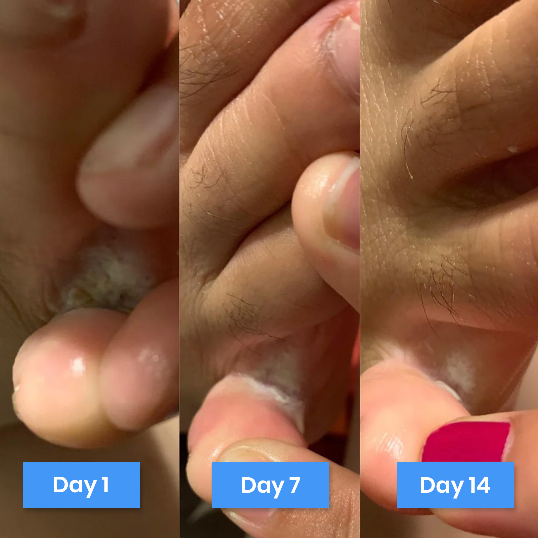 New Aura™ Anti-Fungal Relief Cream