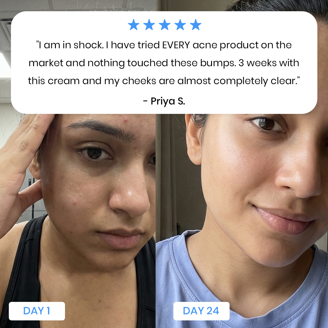 New Aura™ Anti-Fungal Acne Cream