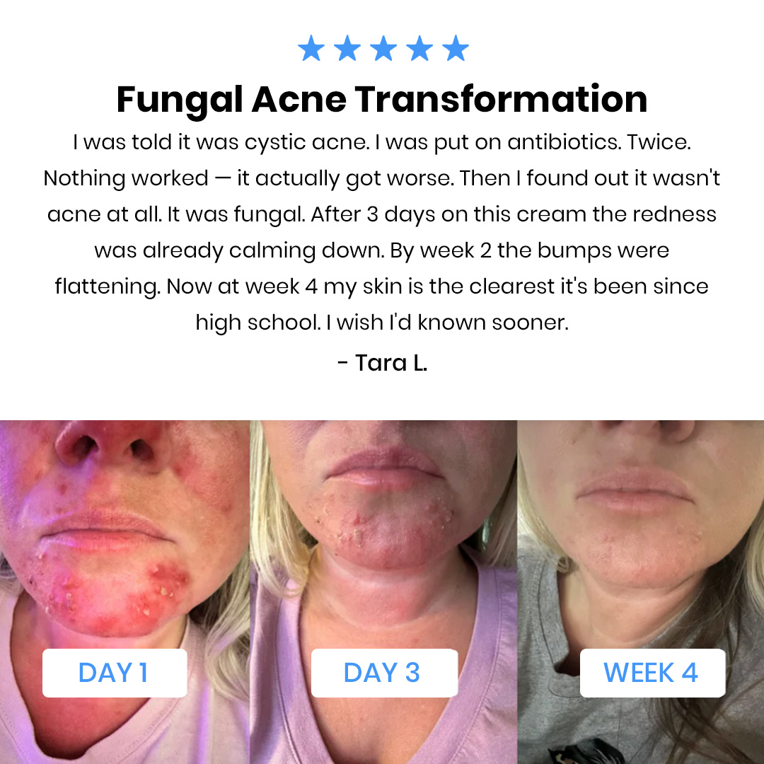 New Aura™ Anti-Fungal Acne Cream
