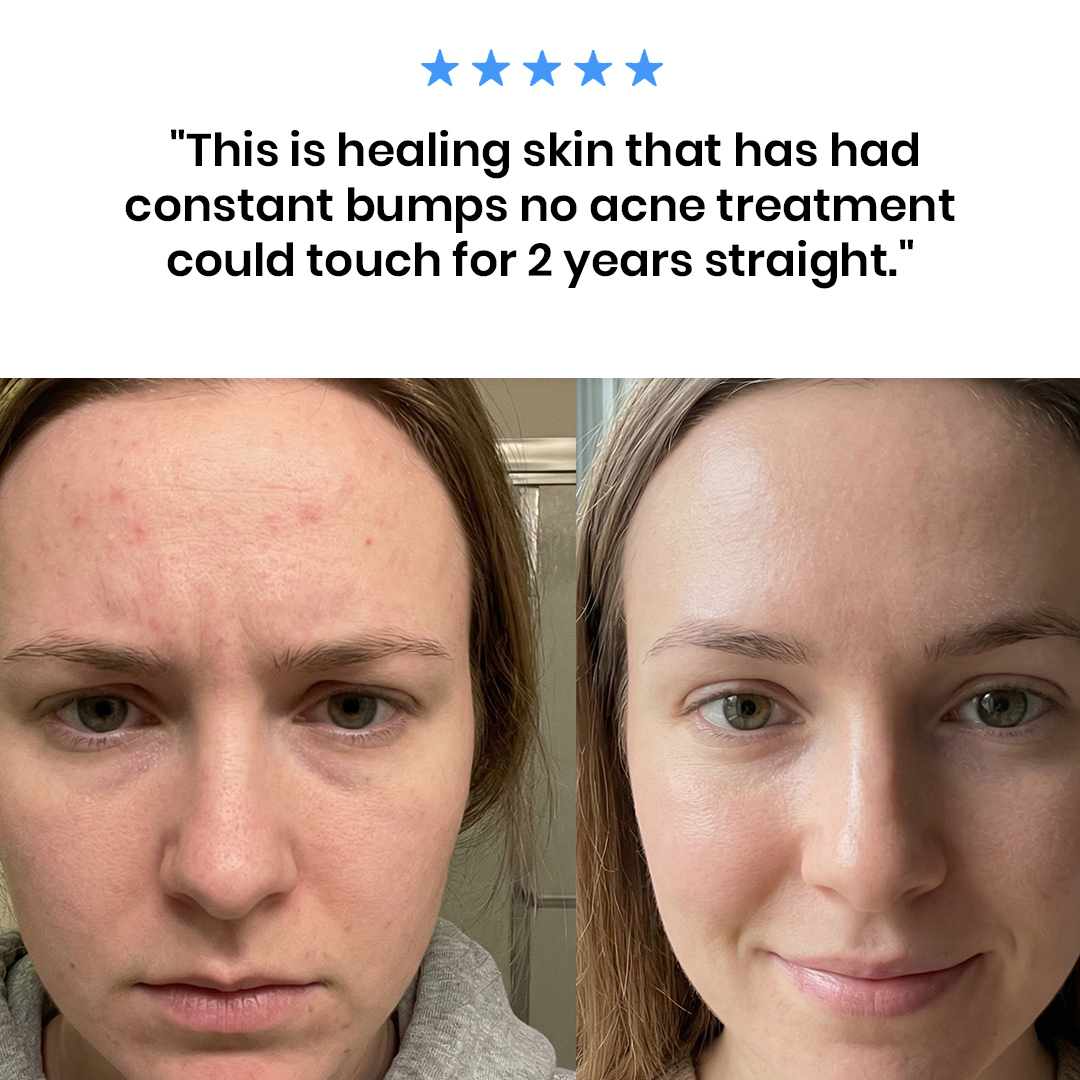 New Aura™ Anti-Fungal Acne Cream