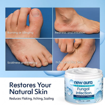 NewAura™ Fungus Cream