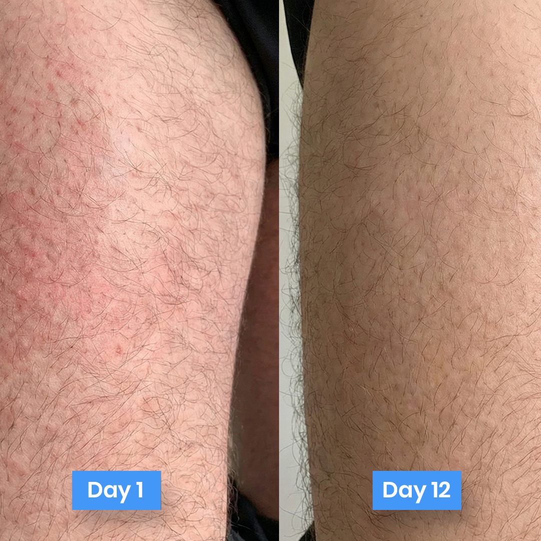 New Aura™ Anti-Fungal Jock Cream