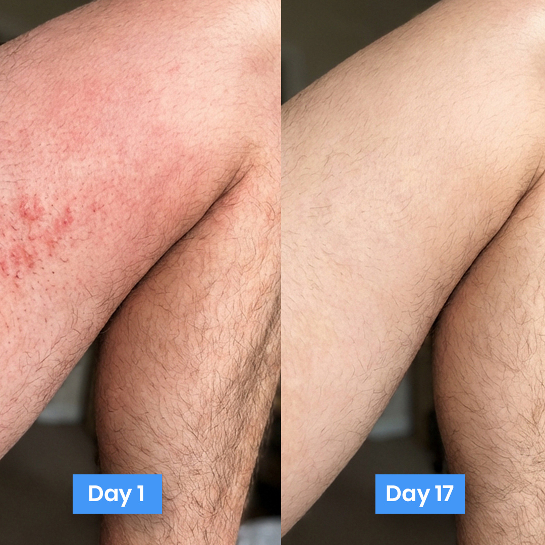 New Aura™ Anti-Fungal Jock Cream