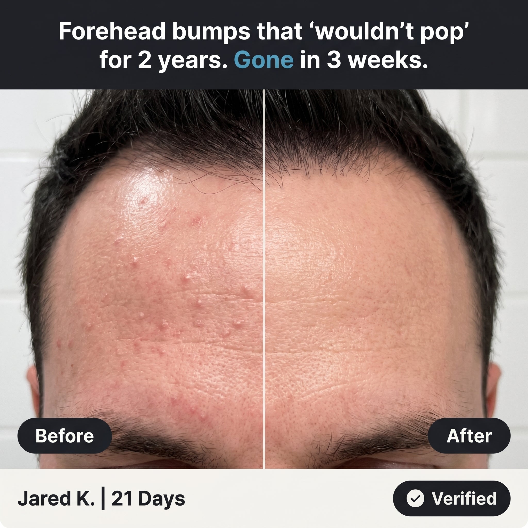 New Aura™ Men's Anti-Fungal Acne Cream