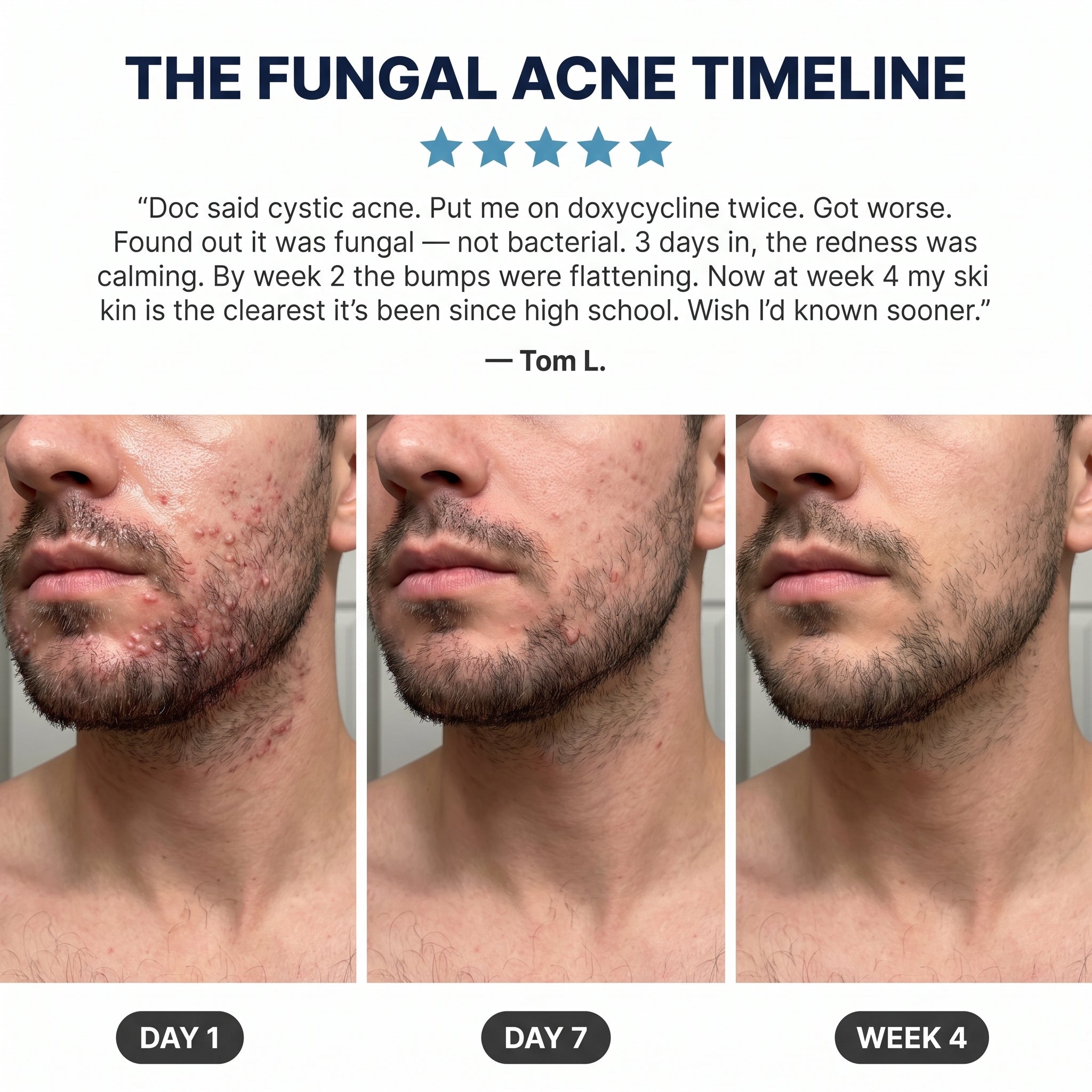 New Aura™ Men's Anti-Fungal Acne Cream