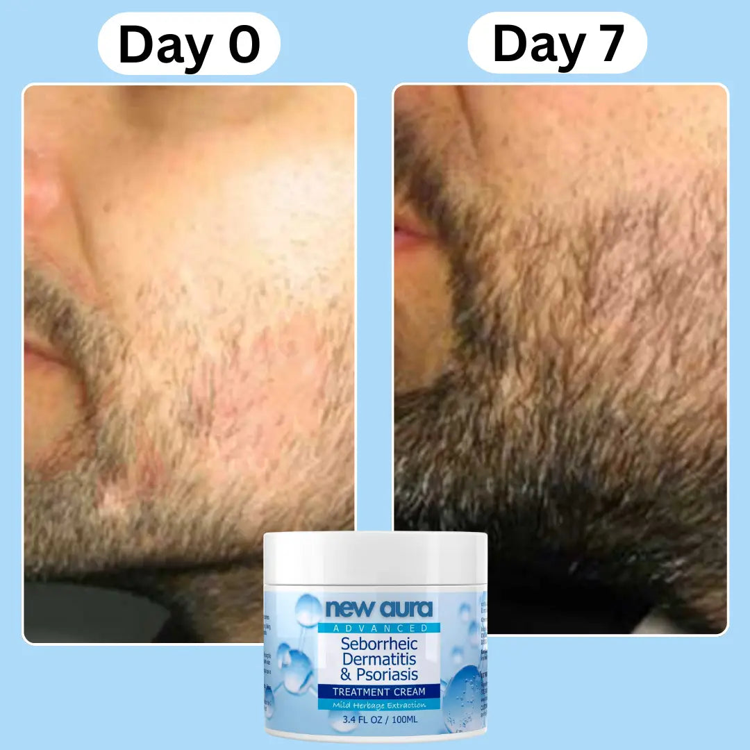 NewAura™ Beard Relief Treatment