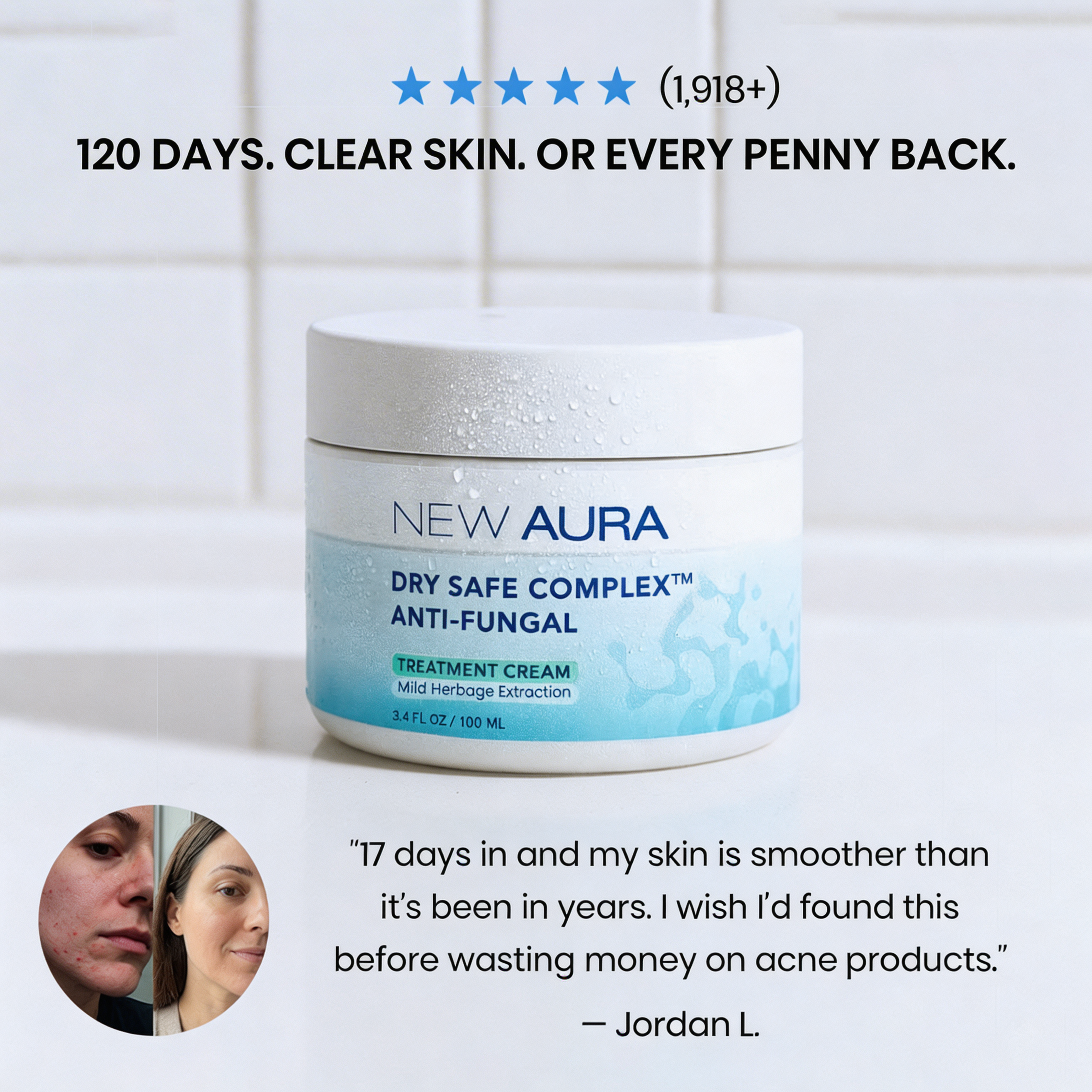 New Aura™ Anti-Fungal Acne Cream